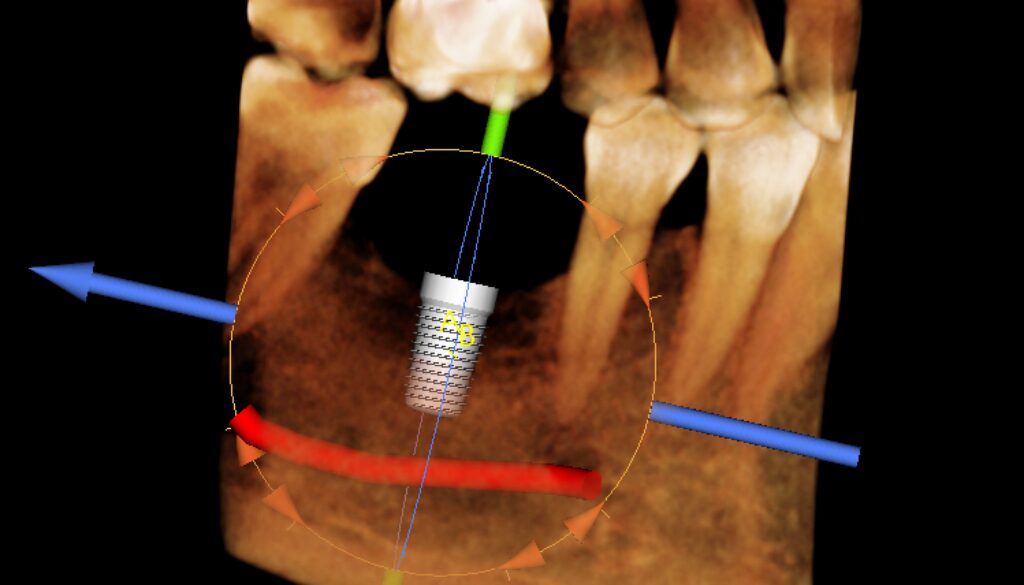 cone beam 1