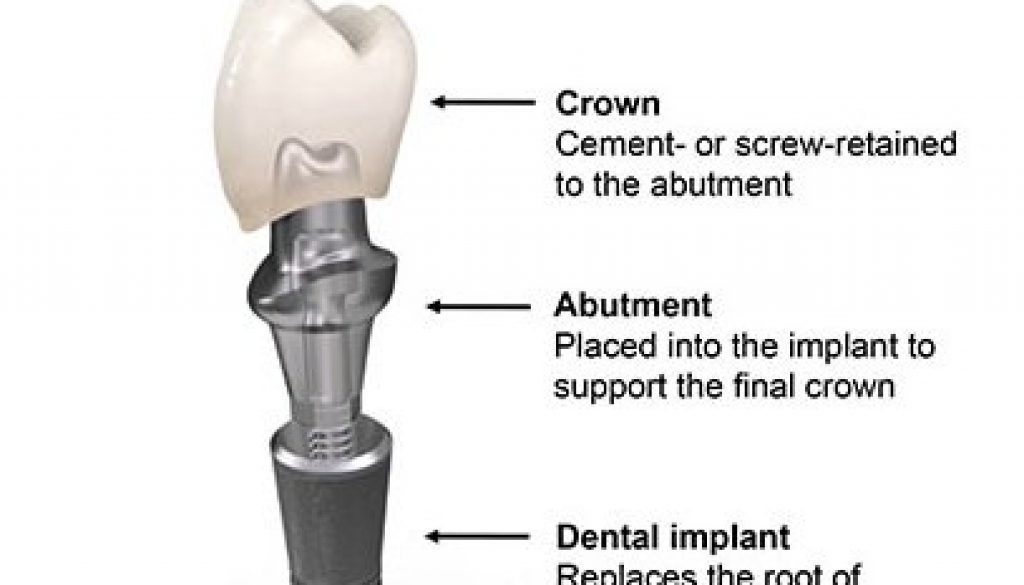 crown-abutment-implant 1